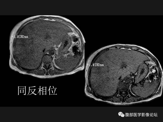 【病例】肝窦阻塞综合征HSOS一例CT及MR