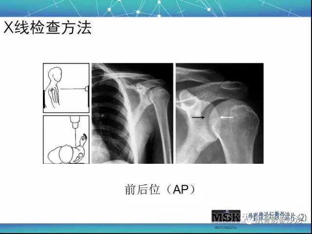 【PPT】肩关节损伤（骨折篇）