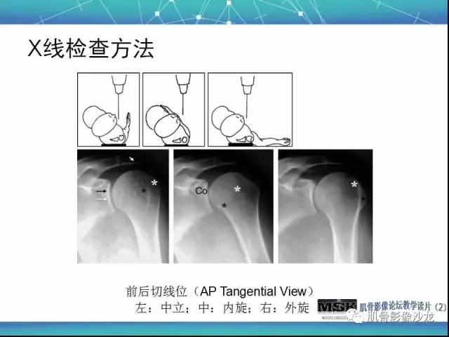 【PPT】肩关节损伤（骨折篇）