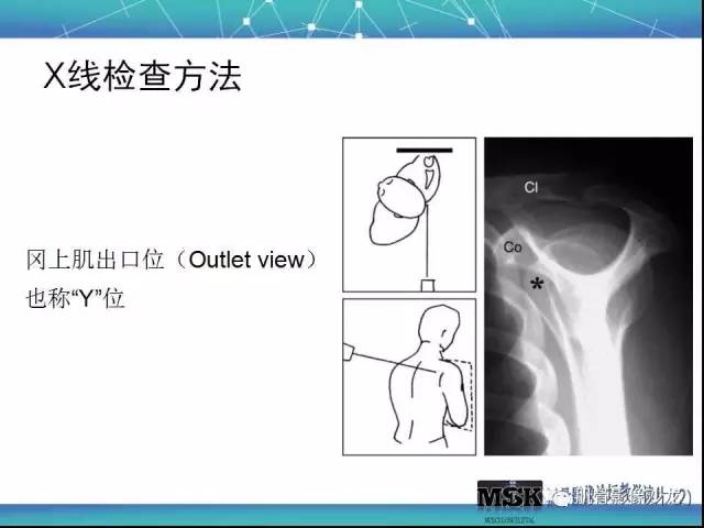 【PPT】肩关节损伤（骨折篇）