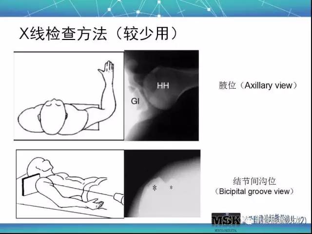 【PPT】肩关节损伤（骨折篇）