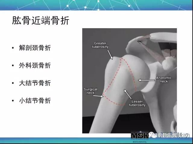 【PPT】肩关节损伤（骨折篇）