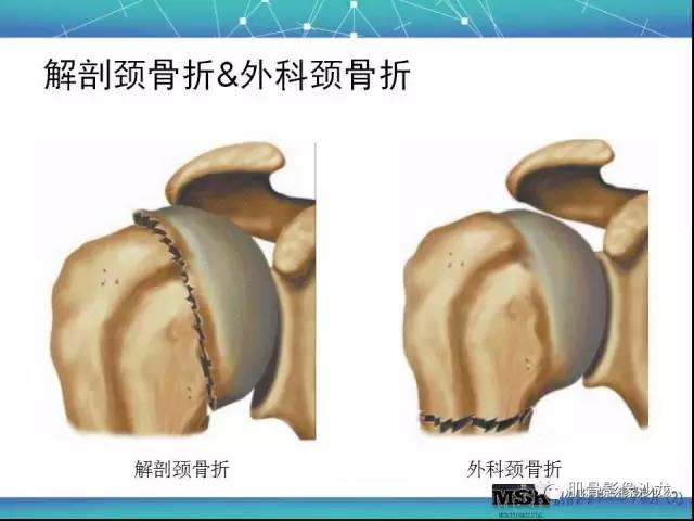 【PPT】肩关节损伤（骨折篇）