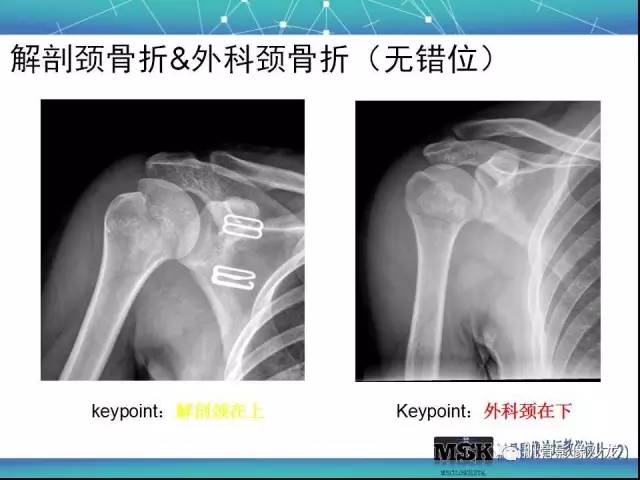 【PPT】肩关节损伤（骨折篇）