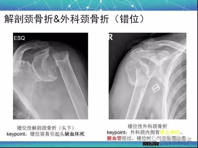 【PPT】肩关节损伤（骨折篇）