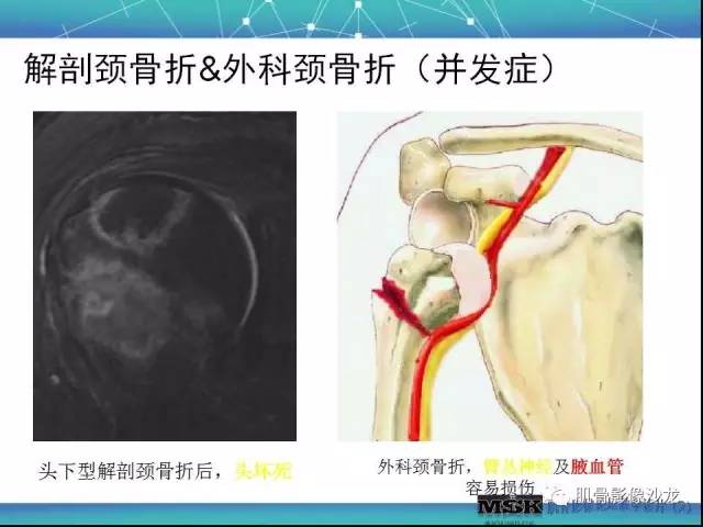 【PPT】肩关节损伤（骨折篇）
