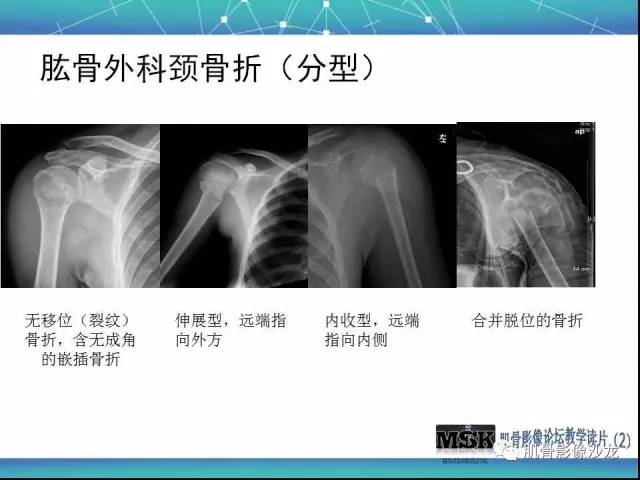 【PPT】肩关节损伤（骨折篇）