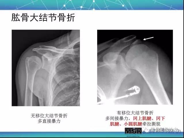 【PPT】肩关节损伤（骨折篇）
