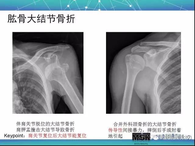 【PPT】肩关节损伤（骨折篇）