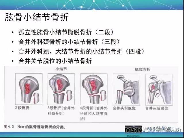 【PPT】肩关节损伤（骨折篇）
