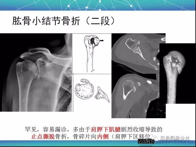 【PPT】肩关节损伤（骨折篇）