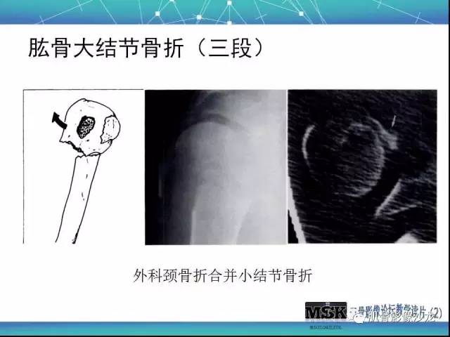 【PPT】肩关节损伤（骨折篇）