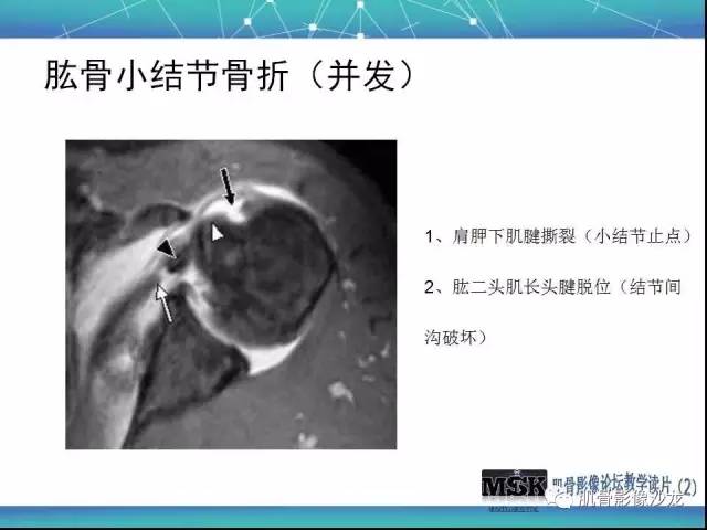 【PPT】肩关节损伤（骨折篇）