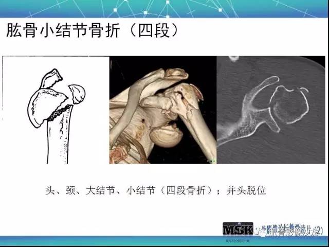 【PPT】肩关节损伤（骨折篇）
