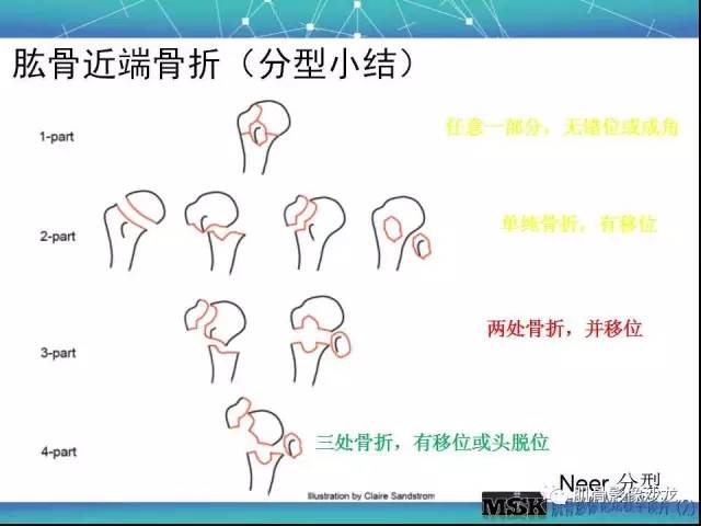 【PPT】肩关节损伤（骨折篇）