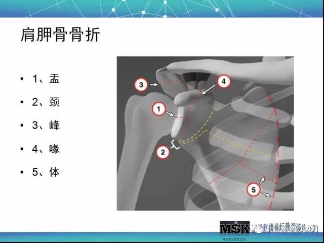 【PPT】肩关节损伤（骨折篇）