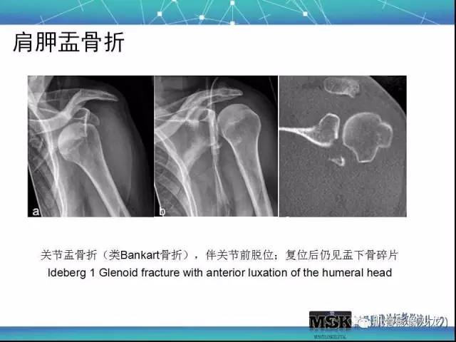 【PPT】肩关节损伤（骨折篇）