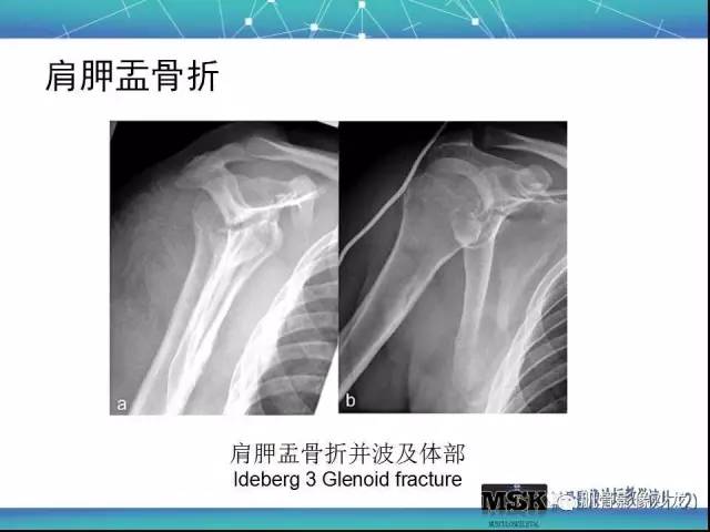 【PPT】肩关节损伤（骨折篇）