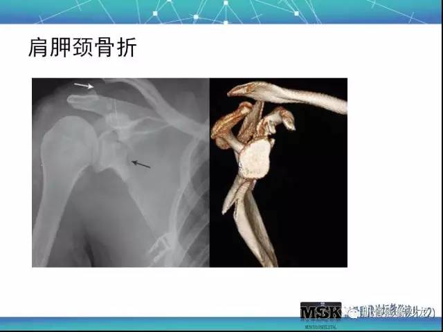 【PPT】肩关节损伤（骨折篇）