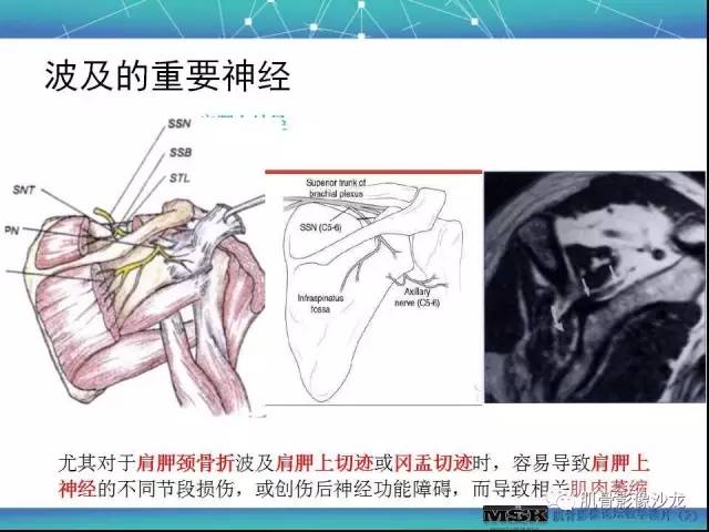 【PPT】肩关节损伤（骨折篇）