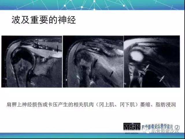 【PPT】肩关节损伤（骨折篇）