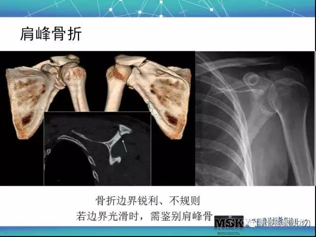 【PPT】肩关节损伤（骨折篇）