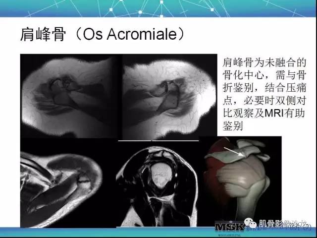 【PPT】肩关节损伤（骨折篇）