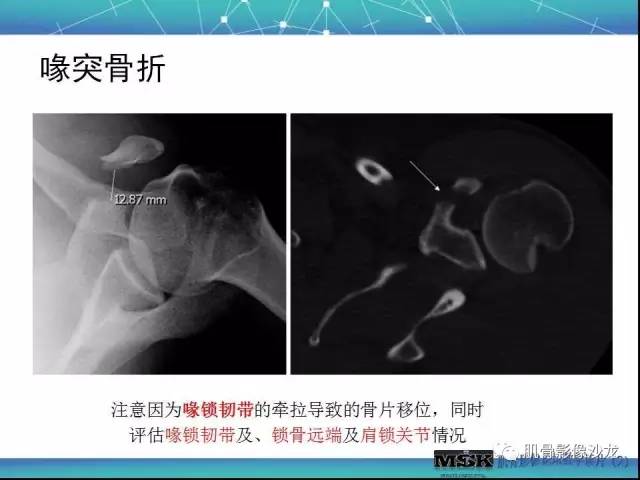 【PPT】肩关节损伤（骨折篇）