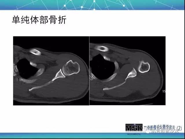 【PPT】肩关节损伤（骨折篇）
