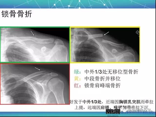 【PPT】肩关节损伤（骨折篇）