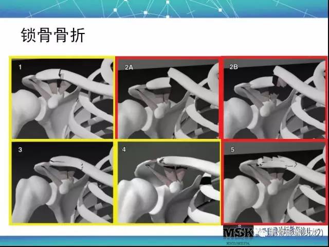【PPT】肩关节损伤（骨折篇）