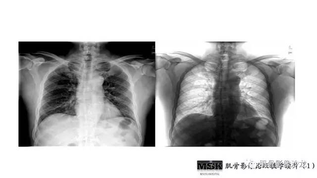 【PPT】肋骨骨折诊断经验分享