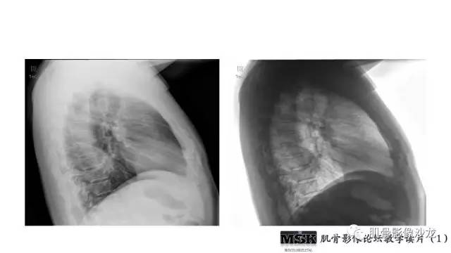 【PPT】肋骨骨折诊断经验分享