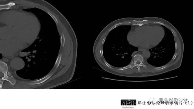 【PPT】肋骨骨折诊断经验分享