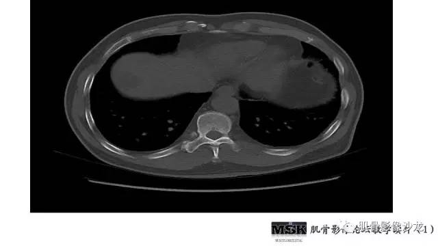 【PPT】肋骨骨折诊断经验分享
