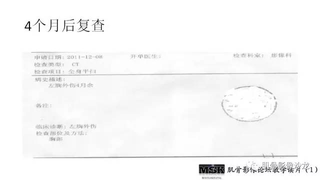【PPT】肋骨骨折诊断经验分享