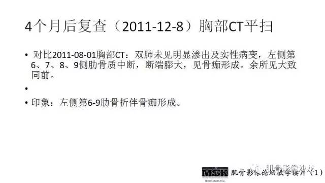 【PPT】肋骨骨折诊断经验分享