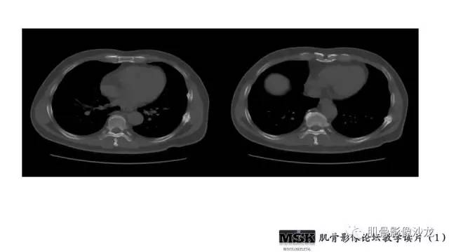 【PPT】肋骨骨折诊断经验分享