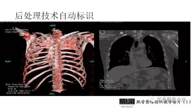 【PPT】肋骨骨折诊断经验分享