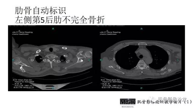 【PPT】肋骨骨折诊断经验分享