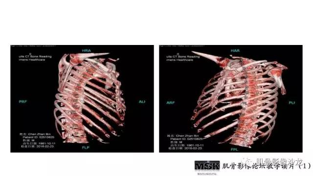 【PPT】肋骨骨折诊断经验分享