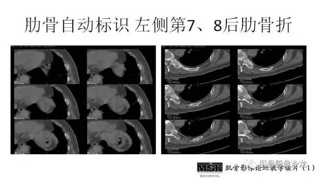 【PPT】肋骨骨折诊断经验分享