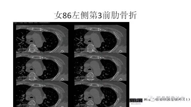 【PPT】肋骨骨折诊断经验分享
