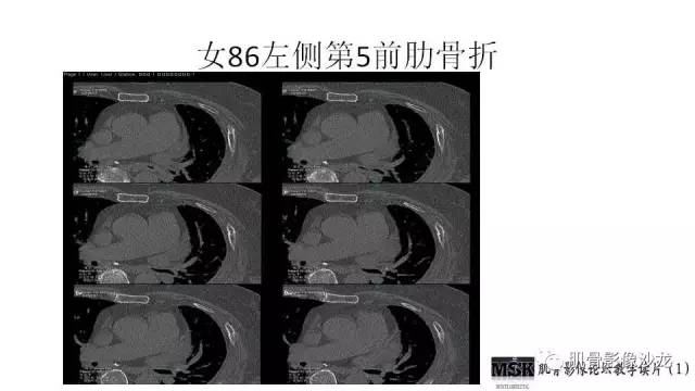 【PPT】肋骨骨折诊断经验分享