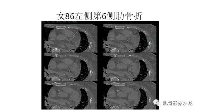 【PPT】肋骨骨折诊断经验分享