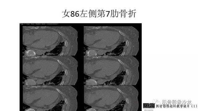【PPT】肋骨骨折诊断经验分享