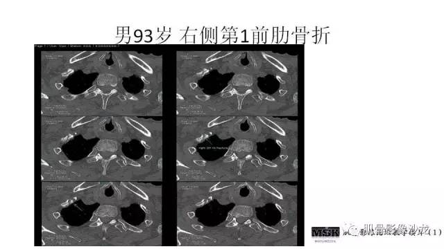 【PPT】肋骨骨折诊断经验分享