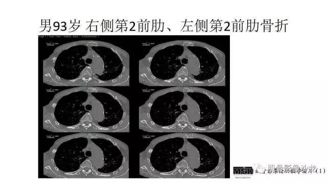 【PPT】肋骨骨折诊断经验分享