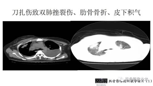 【PPT】肋骨骨折诊断经验分享