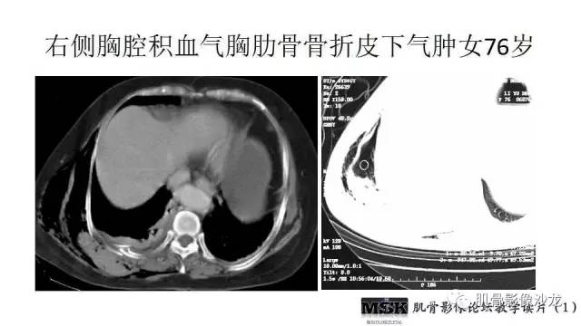 【PPT】肋骨骨折诊断经验分享